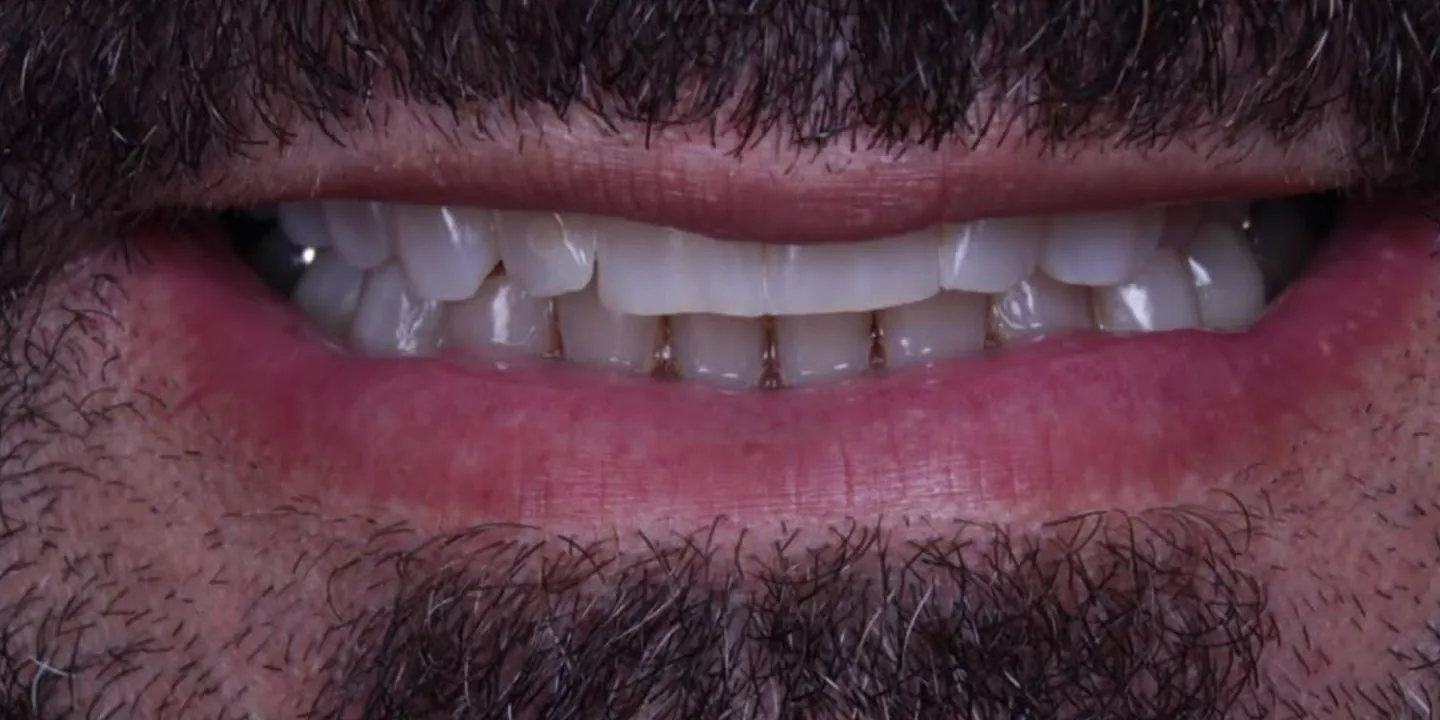 Sorriso de um paciente antes do tratamento, com dentes pequenos, gastos e espaços