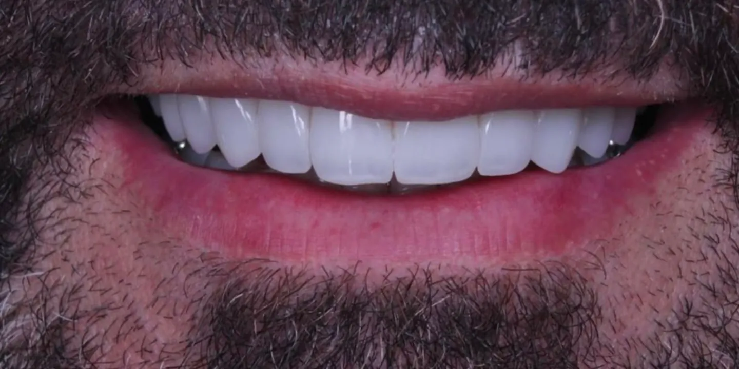 Depois das facetas nos dentes de cima, caso concluído