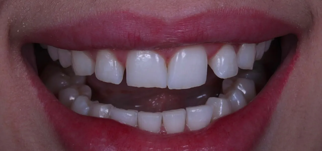 Sorriso de uma paciente antes do tratamento, com espaços entre os dentes da frente