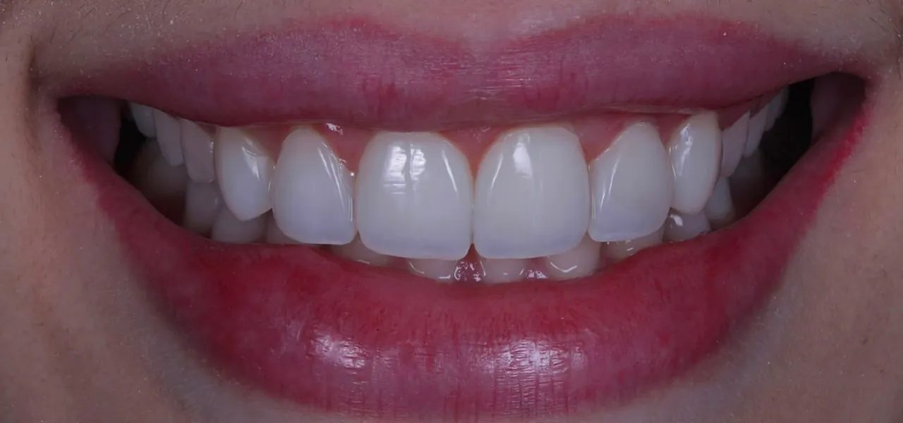 Depois das facetas em resina, com os espaços fechados, caso concluído