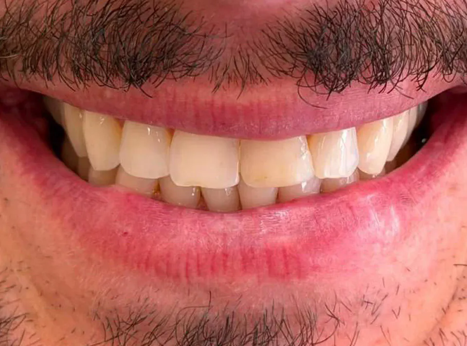 Sorriso de um paciente antes do tratamento, com dentes amarelados e gastos