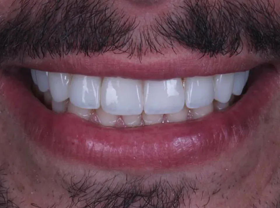 Depois do tratamento com facetas, caso concluído