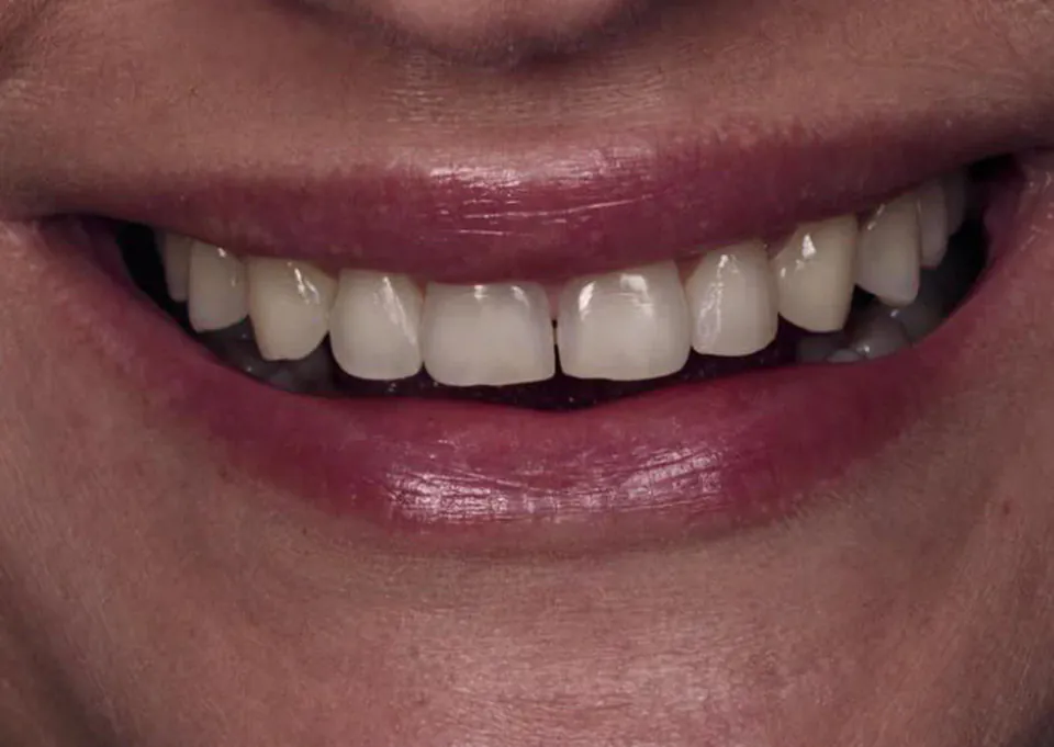 Sorriso de uma paciente antes do tratamento, com dentes amarelados e uma restauração metálica
