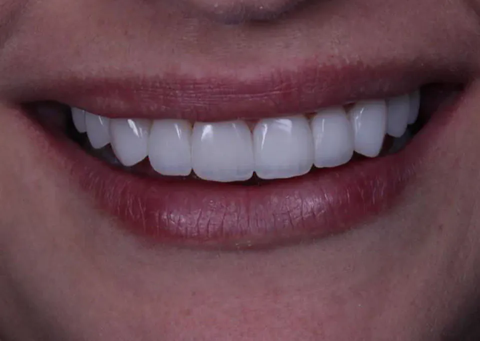 Depois do tratamento com facetas, caso concluído