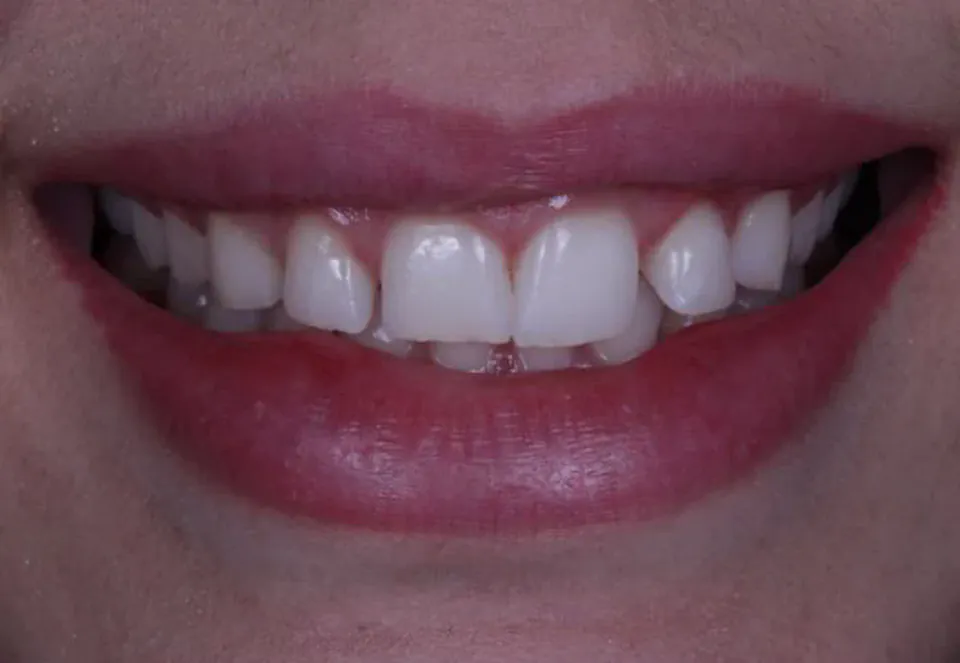 Sorriso de uma paciente antes do tratamento, visto de frente, com espaço entre os dentes da frente
