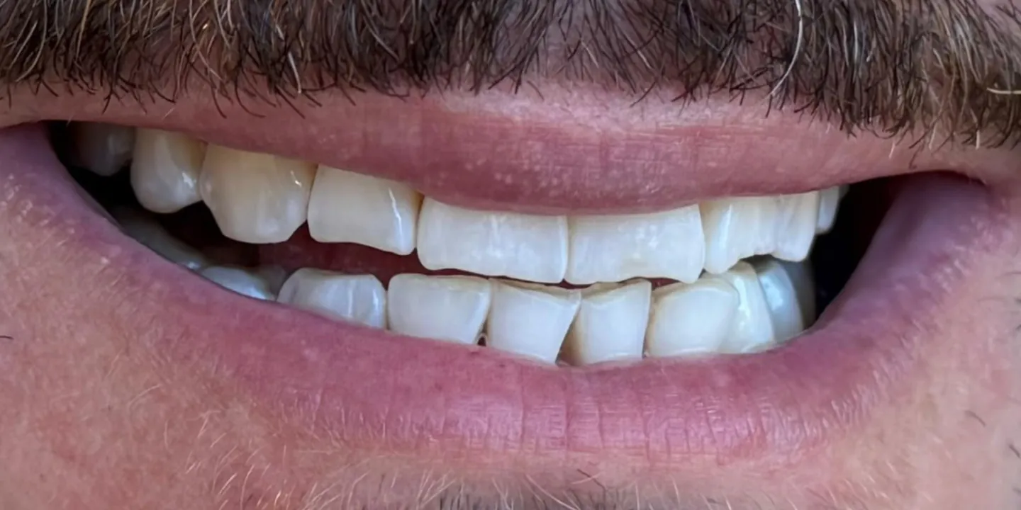 Sorriso de um paciente antes do tratamento, com dentes desalinhados e sobrepostos