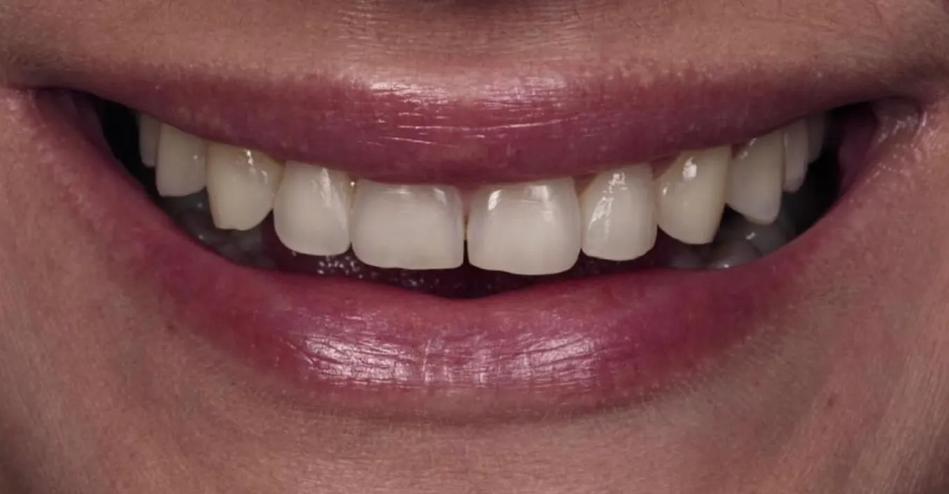 Sorriso de uma paciente antes do tratamento, com dentes amarelados e espaço entre os dentes