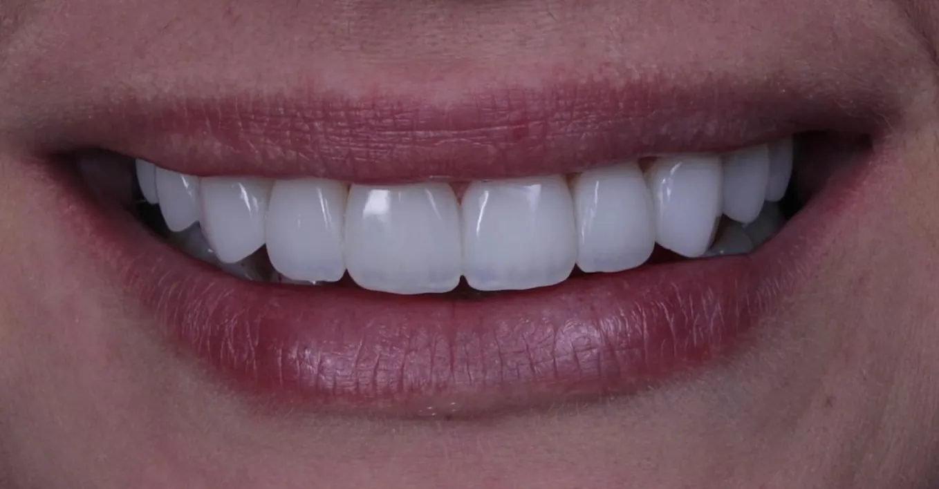 Depois do tratamento com facetas, caso concluído