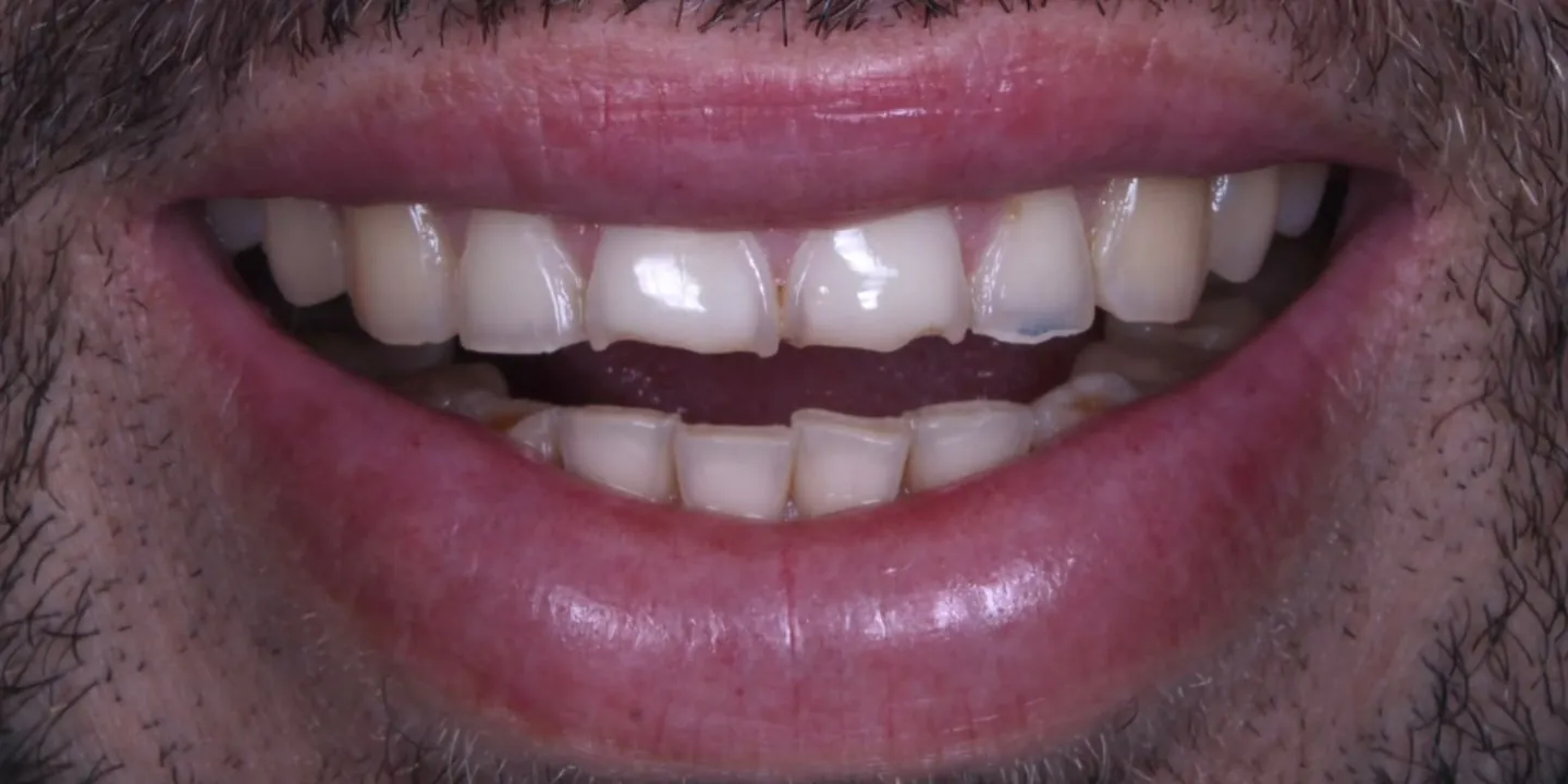 Sorriso de um paciente antes do tratamento, com dentes amarelados e irregulares