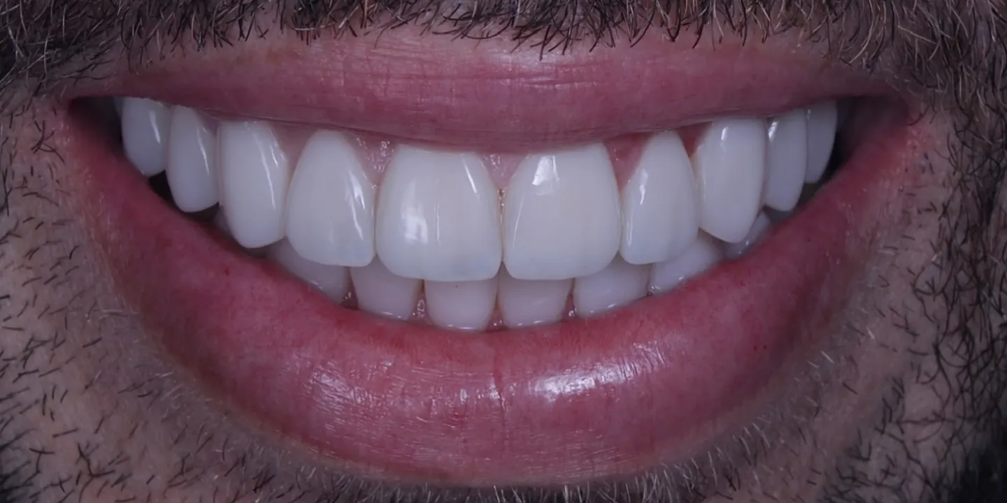 Depois do tratamento com facetas, caso concluído