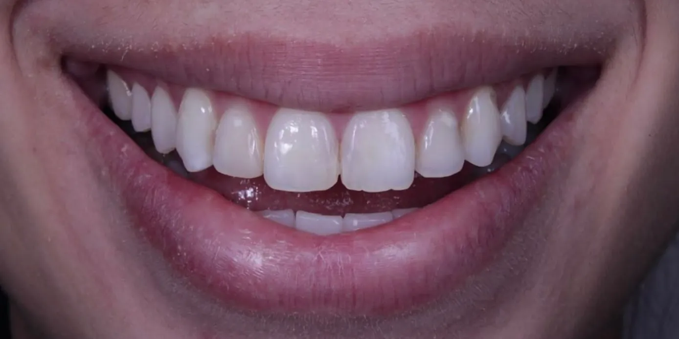 Sorriso de uma paciente antes do tratamento, com pequenas irregularidades no formato dos dentes