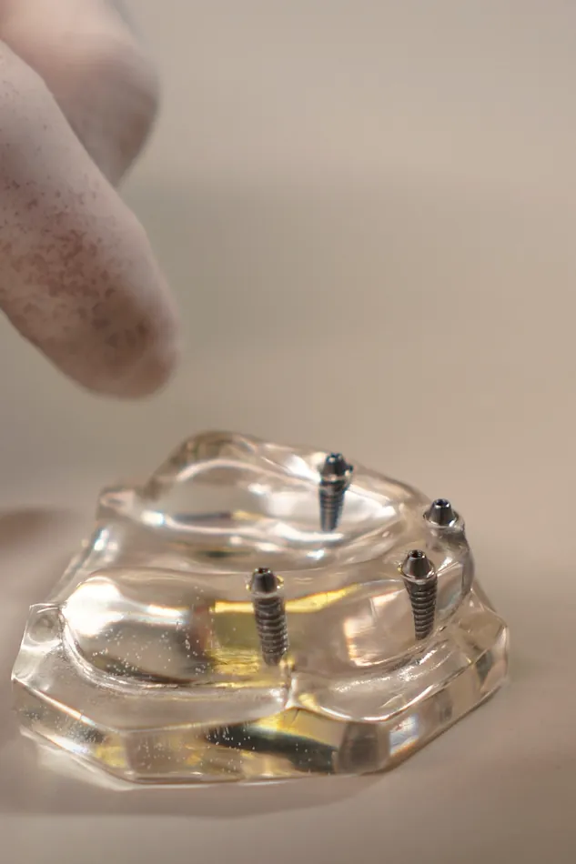 Modelo transparente de prótese protocolo sobre quatro implantes