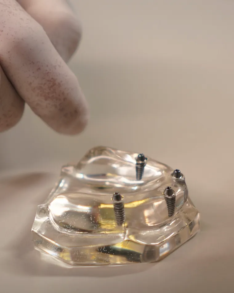 Modelo transparente de prótese protocolo sobre quatro implantes